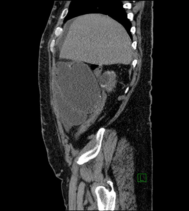 Closed-loop small bowel obstruction-internal hernia (Radiopaedia 78439-91096 C 115).jpg