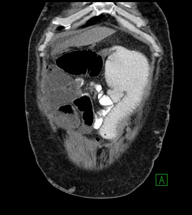Closed-loop small bowel obstruction-internal hernia (Radiopaedia 78439-91096 Coronal non-contrast 24).jpg
