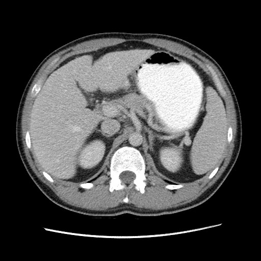 File:Closed-loop small bowel obstruction (Radiopaedia 73713-84509 A 51).jpg