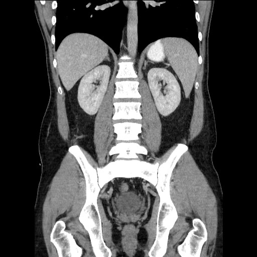 Closed-loop small bowel obstruction (Radiopaedia 73713-84509 C 83).jpg