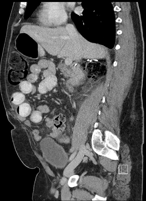 Closed loop obstruction - internal hernia into nephrectomy bed (Radiopaedia 59867-67320 C 59).jpg