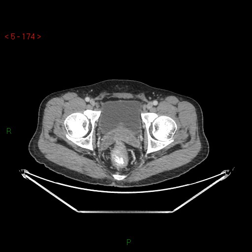 File:Closed loop obstruction and appendicular stump mucocele (Radiopaedia 54014-61158 A 77).jpg