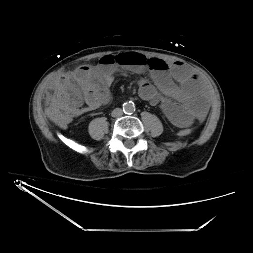 File:Closed loop obstruction due to adhesive band, resulting in small bowel ischemia and resection (Radiopaedia 83835-99023 Axial non-contrast 91).jpg