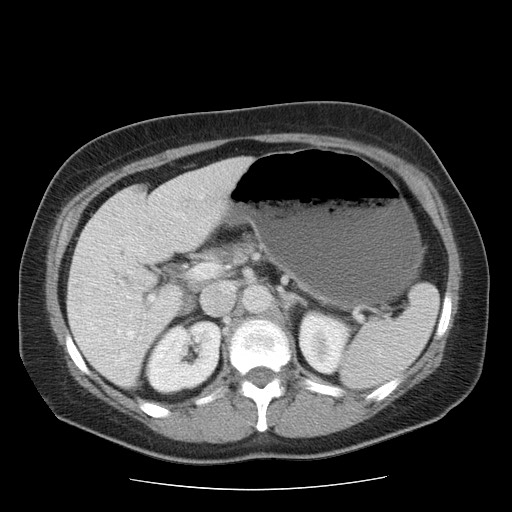 File:Closed loop small bowel obstruction (Radiopaedia 65403-74451 A 24).jpg
