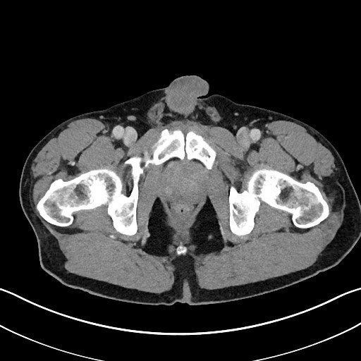 Closed loop small bowel obstruction - internal hernia (Radiopaedia 57806-64778 B 128).jpg
