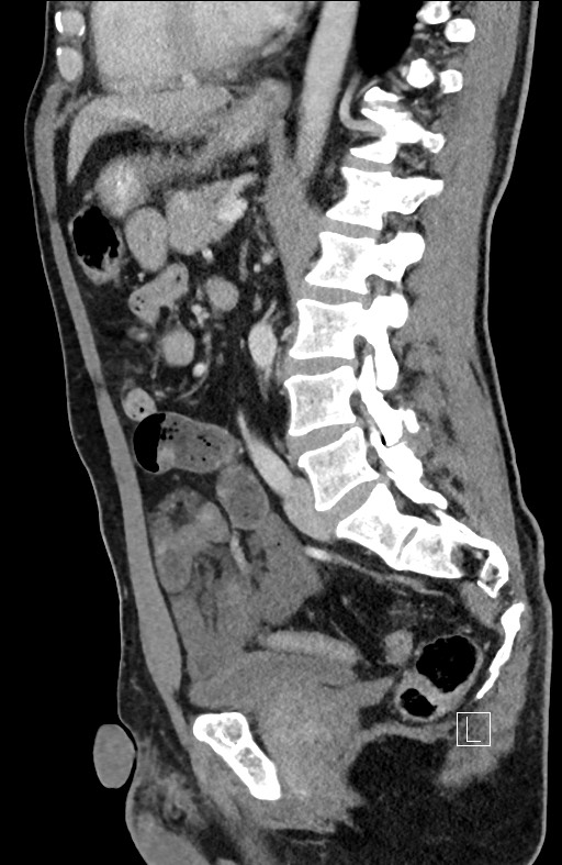 Closed loop small bowel obstruction - internal hernia (Radiopaedia 57806-64778 C 51).jpg