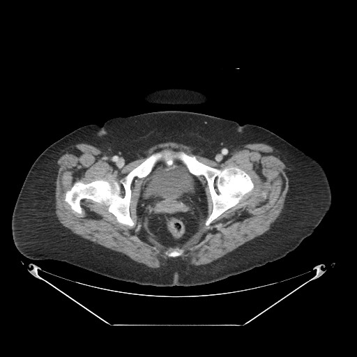 Closed loop small bowel obstruction - internal hernia (Radiopaedia 65402-74450 A 130).jpg