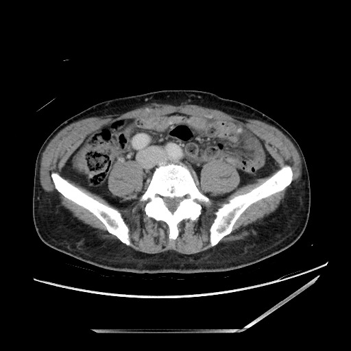 Closed loop small bowel obstruction - omental adhesion causing "internal hernia" (Radiopaedia 85129-100682 A 109).jpg