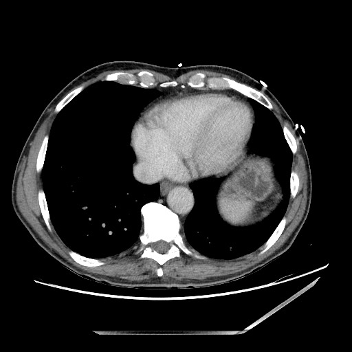Closed loop small bowel obstruction - omental adhesion causing "internal hernia" (Radiopaedia 85129-100682 A 8).jpg
