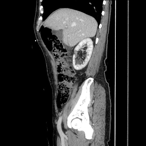 Closed loop small bowel obstruction - omental adhesion causing "internal hernia" (Radiopaedia 85129-100682 C 59).jpg