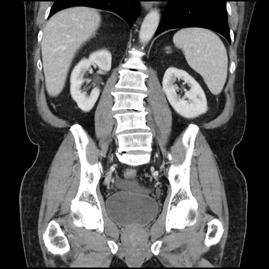 Closed loop small bowel obstruction due to adhesive band - U-shaped loop (Radiopaedia 83829-99012 B 33).jpg