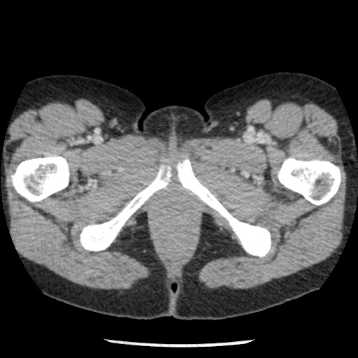 Closed loop small bowel obstruction due to trans-omental herniation (Radiopaedia 35593-37109 A 91).jpg