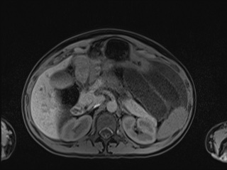 Closed loop small bowel obstruction in pregnancy (MRI) (Radiopaedia 87637-104031 Axial T1 fat sat 40).jpg