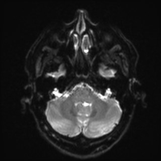 Cochlear incomplete partition type III associated with hypothalamic hamartoma (Radiopaedia 88756-105498 Axial DWI 9).jpg