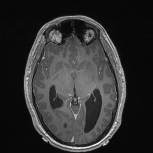 File:Colloid cyst (Radiopaedia 44510-48181 Axial T1 C+ 85).png