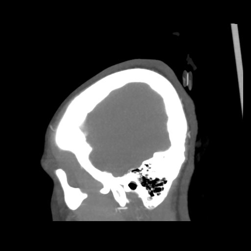 Colloid cyst (resulting in death) (Radiopaedia 33423-34499 B 6).png