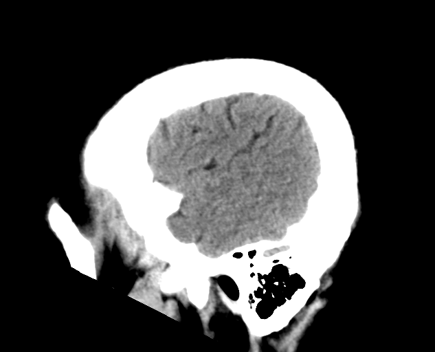 File:Colloid cyst of the third ventricle (Radiopaedia 86571-102661 B 6).png