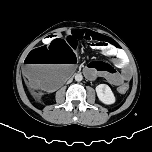 Colocolic intussusception due to large lipoma (Radiopaedia 68773-78482 A 90).jpg