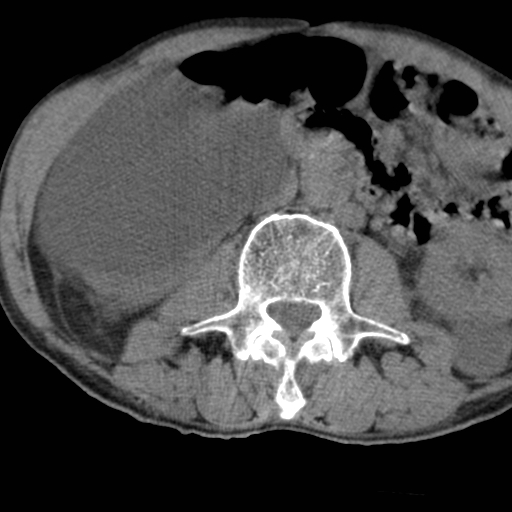 File:Colon cancer with calcified liver metastasis (Radiopaedia 74423-85309 Axial non-contrast 49).jpg