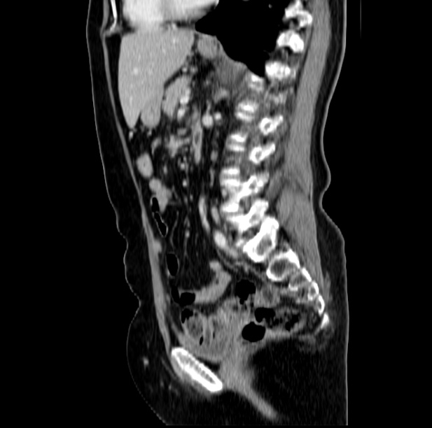 Colon carcinoma with hepatic metastases (Radiopaedia 29477-29961 C 32).jpg