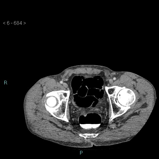 File:Colonic cancer (ultrasound and TC imaging) (Radiopaedia 50346-55713 A 133).jpg