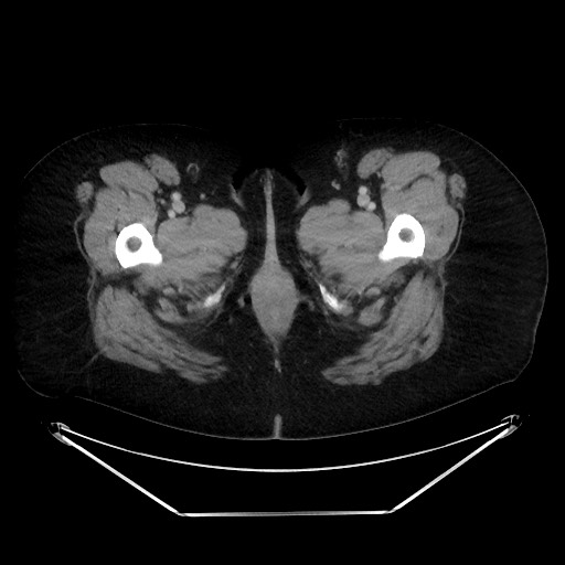File:Colonic intussusception due to adenocarcinoma (Radiopaedia 86828-102987 Axial 156).jpg