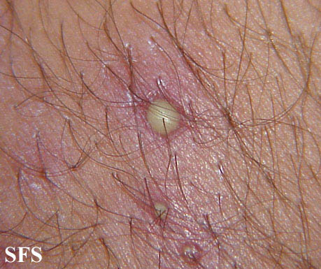 File:Folliculitis (Dermatology Atlas 9).jpg