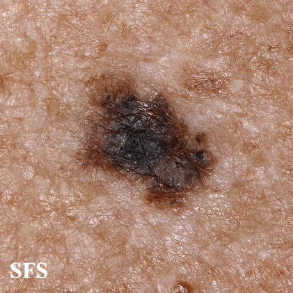 File:Melanoma (Dermatology Atlas 59).jpg