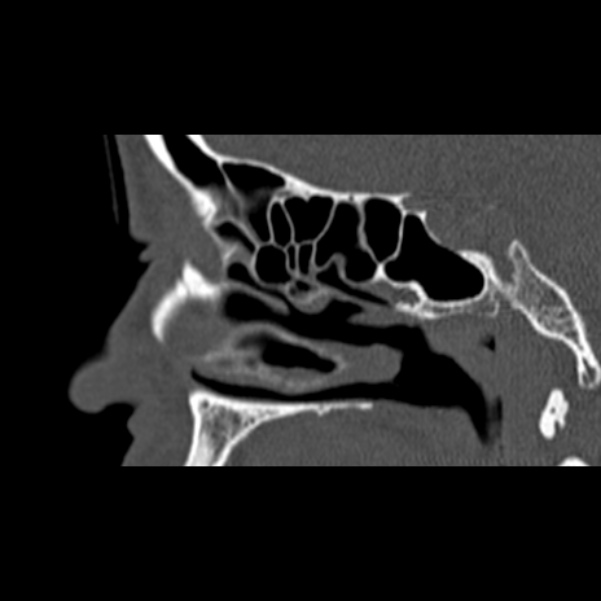Nasal septal perforation (Radiopaedia 25030-25289 Sagittal bone window 42).jpg