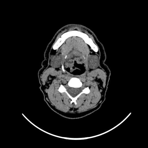 File:Nasopharyngeal carcinoma - infiltrating the clivus (Radiopaedia 62583-70875 Axial non-contrast 41).jpg