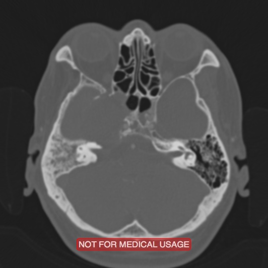 Nasopharyngeal carcinoma recurrence - skull base destruction (Radiopaedia 29107-29490 Axial bone window 80).jpg