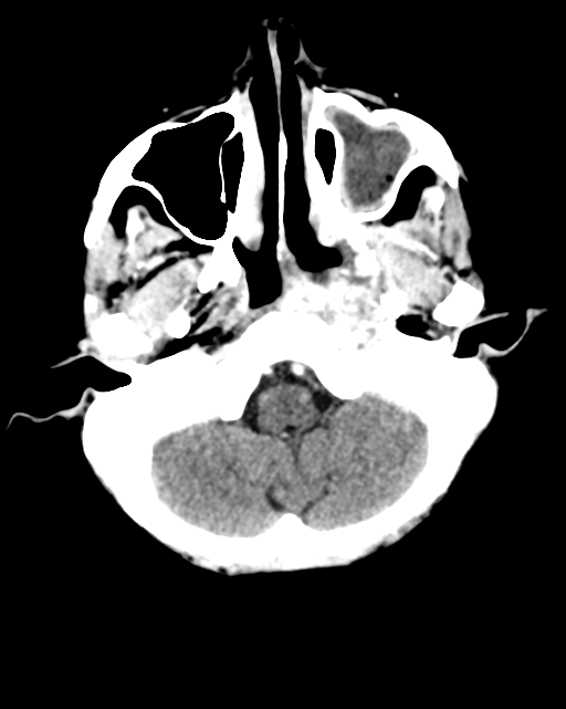 Nasopharyngeal carcinoma with cerebral abscess (Radiopaedia 43018-46275 Axial C+ delayed 10).png