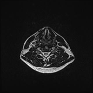 Nasopharyngeal carcinoma with perineural spread (Radiopaedia 55030-61380 Axial T2 63).jpg