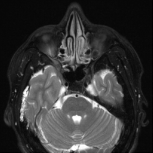 File:Nasopharyngeal carcinoma with pterygopalatine fossa involvement (Radiopaedia 33102-34134 Axial T2 22).png