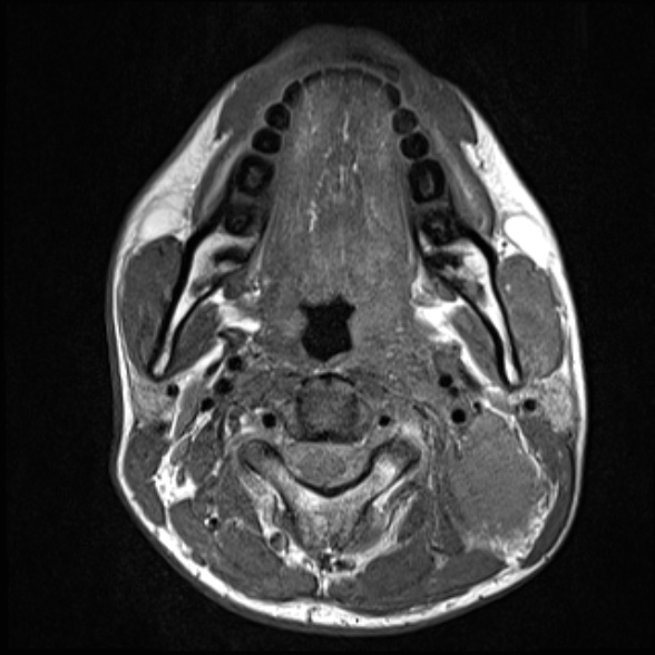 Nasopharyngeal carcinoma with skull base invasion (Radiopaedia 53415-59485 Axial T1 42).jpg