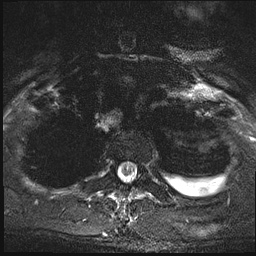 File:Nasopharyngeal carcinoma with skull base invasion (Radiopaedia 59258-66600 Axial T2 fat sat 23).jpg