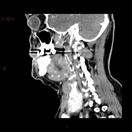 File:Nasopharyngeal lymphoma (Radiopaedia 54235-60432 B 1).jpg