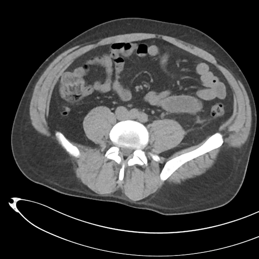 File:Necrotizing pancreatitis with acute necrotic collections (Radiopaedia 38829-41012 Axial non-contrast 52).png