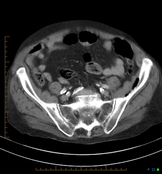 Necrotzing fasciitis due to a perforated adenocarcinoma of the splenic flexure (Radiopaedia 46930-51455 A 48).jpg