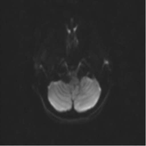 Neurenteric cyst (Radiopaedia 58641-65837 Axial DWI 41).png