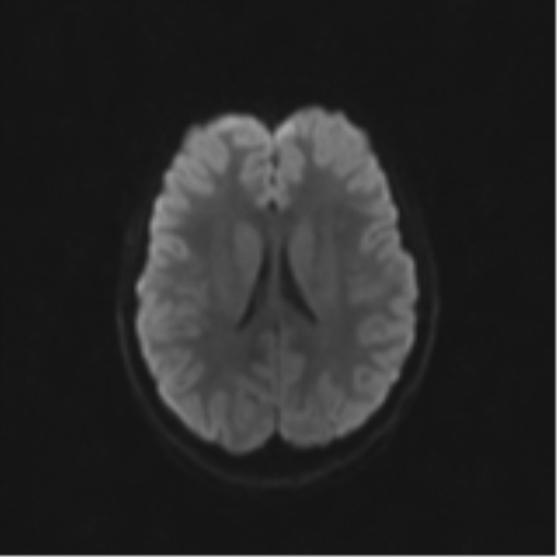 Neurenteric cyst (Radiopaedia 58641-65837 Axial DWI 57).png