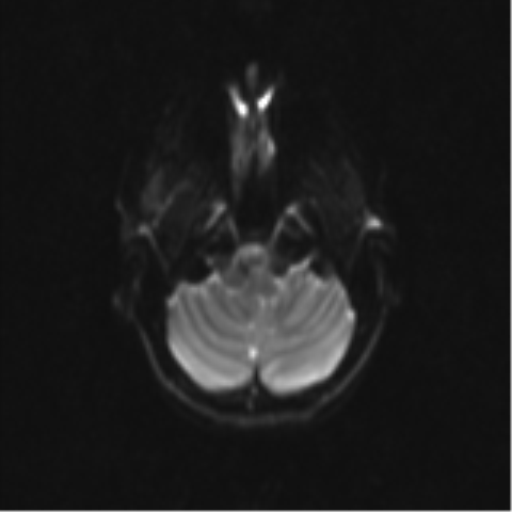 Neurenteric cyst (Radiopaedia 58641-65837 Axial DWI 7).png