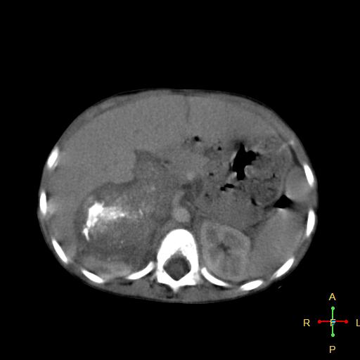 File:Neuroblastoma (Radiopaedia 24751-25016 D 13).jpg