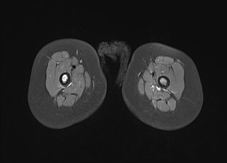 File:Neuroblastoma with bone metastases (Radiopaedia 67080-76414 Axial T1 C+ fat sat 32).jpg