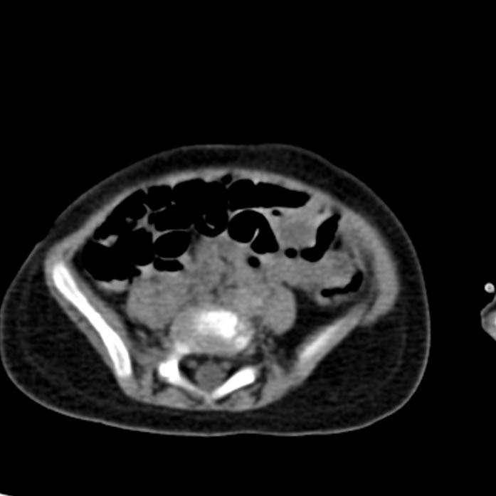 Neuroblastoma with skull metastases (Radiopaedia 30326-30960 Axial non-contrast 43).jpg