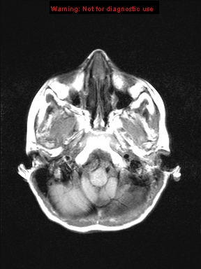 File:Neurofibromatosis type 1 with optic nerve glioma (Radiopaedia 16288-15965 Axial T1 21).jpg