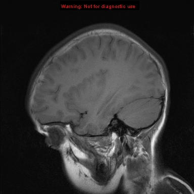 File:Neurofibromatosis type 1 with optic nerve glioma (Radiopaedia 16288-15965 Sagittal T1 18).jpg
