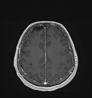 Neurofibromatosis type 2 (Radiopaedia 79097-92049 Axial T1 C+ 148).jpg