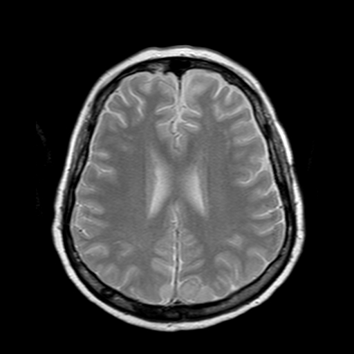 File:Neurofibromatosis type 2 (Radiopaedia 8713-9518 Axial Gradient Echo 9).jpg