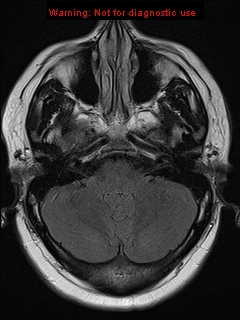 File:Neuroglial cyst (Radiopaedia 10713-11184 Axial FLAIR 18).jpg